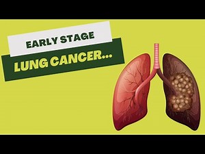 Early Stage Non-Small Cell Lung Cancer | 3D Medical Animation | Pixeldust Studios