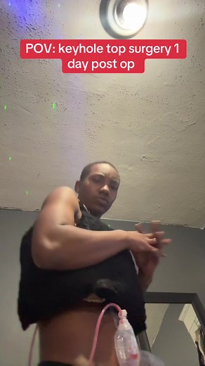 Keyhole Top Surgery Journey: One Day Post-Op