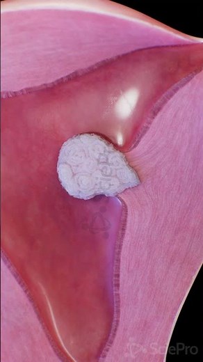 ubmucosal Pedunculated Fibroid | 3D Uterine Animation