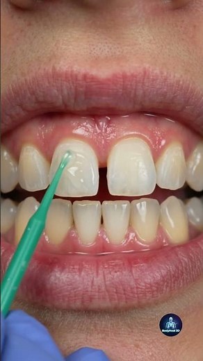 Close your teeth gap fast #diastema #oralhealth #teethgap #dentalcare #confidentsmile