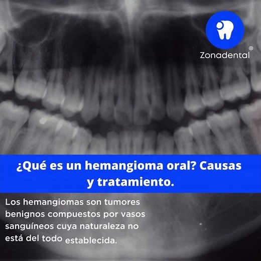 ¿Qué es un hemangioma oral? Causas y tratamiento.