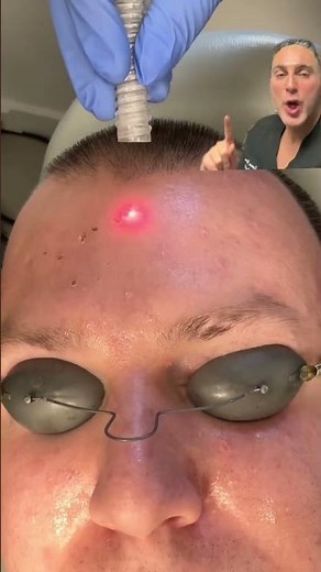 CO2 Laser Treatment of Sebaceous Hyperplasia