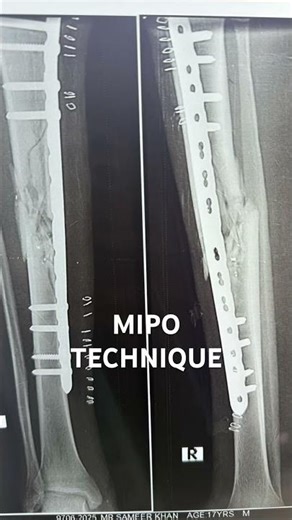 Mipo technique / bridge mode