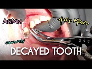 [ASMR] Decayed Tooth Extraction