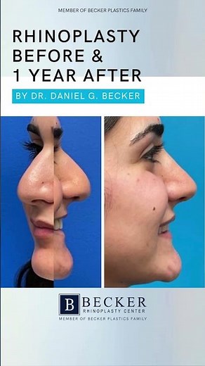 Smoother Bridge and Refined Tip at 1 Year 💖👃 | Rhinoplasty by Dr. Becker