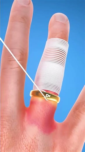 How to Remove a Stuck Ring Using a Thread #shorts