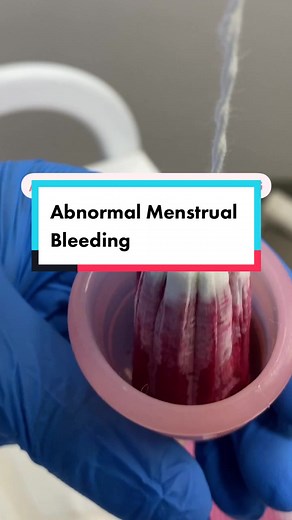 Abnormal menstrual bleeding refers to any changes or irregularities in a woman’s menstrual cycle. Here are five signs of abnormal menstrual bleeding: Heavy or prolonged bleeding: Menstrual bleeding that is unusually heavy or lasts longer than seven days is considered abnormal. This may involve soaking through sanitary pads or tampons more frequently than usual or passing large blood clots. Irregular cycle length: A regular menstrual cycle typically occurs every 21 to 35 days. If there are signif
