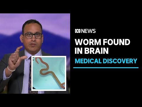 Surgeons pull an 8cm worm from woman's brain in Canberra | ABC News