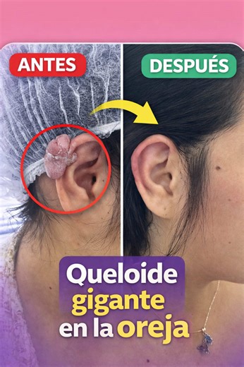 Muchos piensan que los queloides no tienen solución… Este queloide auricular era grande, causaba molestias y afectaba su seguridad. Realizamos la extirpación y así luce 2 meses después. ✨ Cada caso debe evaluarse de forma individual, pero los cambios pueden ser muy significativos. 💬 ¿Sabías que los queloides se pueden tratar? 📩 Cuéntame en comentarios si conoces a alguien con uno. . . . . #parariiiiiiiiiiiiiiiiiiiiiiiiiiiiiiiiii #parati #q#queloidecicatriz #chile