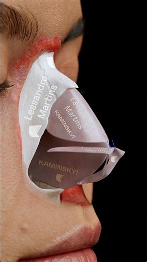 Fish Bone Rhinoplasty ⭕️ Lessandro Martins & KAMINSKYI