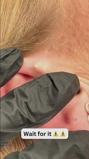 Large Blackheads Extraction Big Cystic Acne Blackheads&Whiteheads Removal Pimple Popping #1140 2026