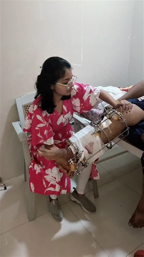 Dr. Drashti Jotaniya on Instagram: "👉🏻The Ilizarov technique is mainly a method used for bone lengthening, deformity correction, and complex fracture management, especially in the lower limbs. 👉🏻It involves the use of an external fixator to apply controlled tension, which stimulates new bone growth (distraction osteogenesis). 👉🏻Important point: The Ilizarov technique is not directly used for quadriceps strengthening. But after Ilizarov fixator appl