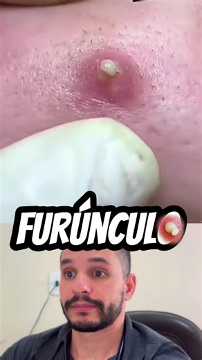 Furúnculo: Causas e Tratamentos Eficazes
