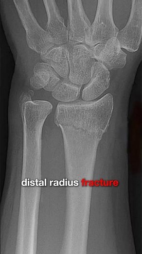 2/3 What Is a ‘Colles’ Wrist Fracture ?