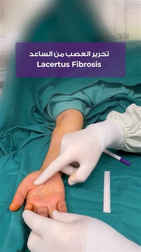 Dr.Abdallah Masadeh on Instagram‎: "Credit goes to Dr.Elezabith Hagart @dr.hagert for giving me the perfect way and steps for Nerve release at the level of lacertus fibrosis and pronator syndrome .. thank you Doc 🙏 .. in this case the patient done her carpal tunnel release and still complaining of muscle weakness in her hand .. and after release of lacertus fibrosis under local anasthesia .. she had her power back IMMEDIATELY 🤩 يعود الفضل للدكتوره اليزابيث هاجرت في اعطائي افضل النصائح والخطوات