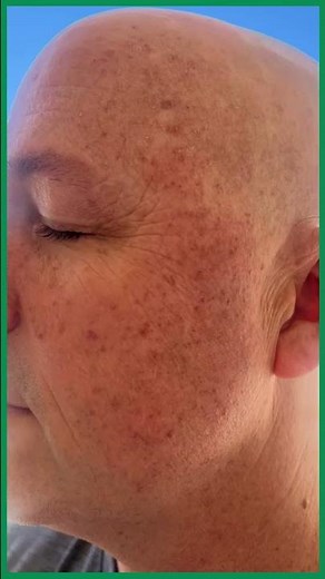 Hyperpigmentation Treatment: Before & After One Laser Session