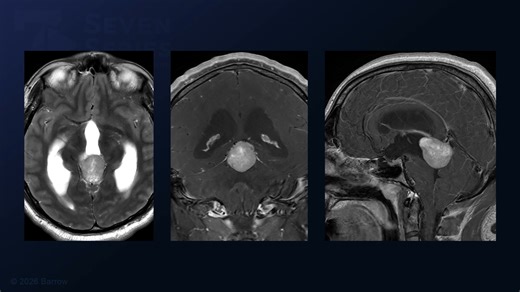 #513: Torcular Craniotomy and Supracerebellar Infratentorial Approach for Resection of a Large Pineal Tumor - All Videos - Seven Series Collection