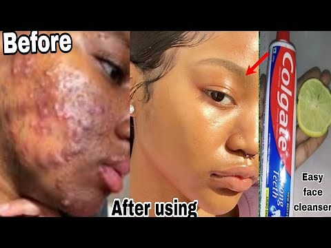 colgate toothpaste for face whitening/ lemon and colgate how to use lemon and teethpast on face mask