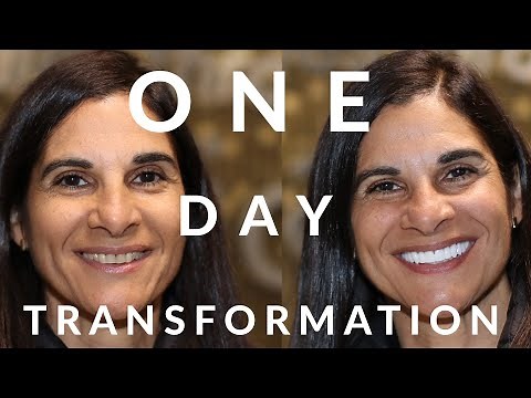 Cosmetic Dental Veneers Review - One Day Smile Makeover from Florida
