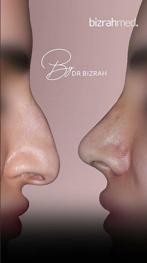 Nose Surgery Before & After | Nose Job Before and After by Dr. Bashar Bizrah, Dubai/London
