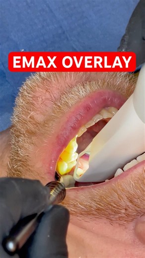 Broken Tooth ➜ Invisible E.max Overlay Transformation 🤯🦷 #shorts #dentist