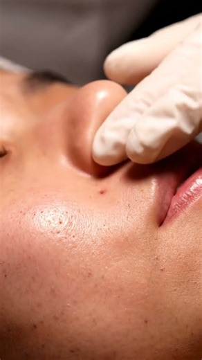 Cheek Blackhead Suction | Ultra Realistic ASMR Extraction 022