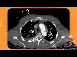 Type B Aortic Dissection with Visceral Ischemia