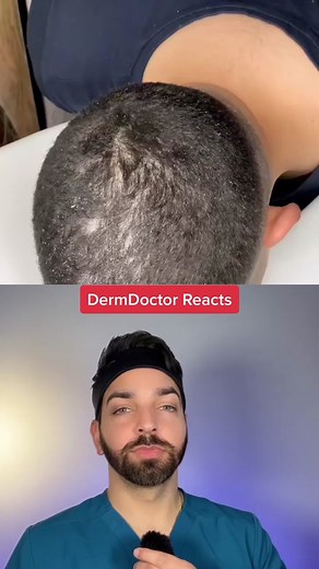 DermDoctor Reacts to Lemon for Dandruff Treatment