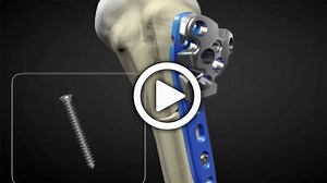 PHP Proximal Humerus Plate Surgical Technique