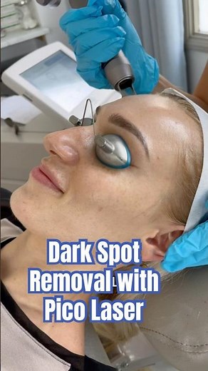 Dark Spot Removal With Pico Laser | Skin Works Medical Spa #1 Med Spa