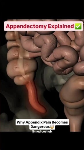 Appendix Surgery Explained | Why Appendicitis Becomes Dangerous#shorts #appendix #surgery #viral #yt