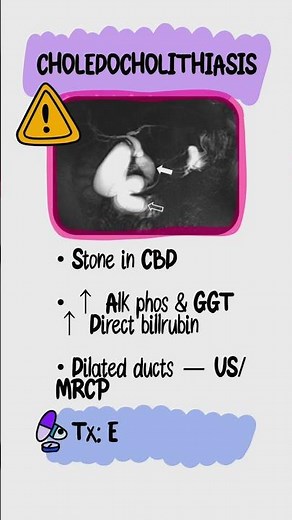 Struggling to sort post-meal RUQ pain on Step 1, Step 2, or clinical rotations?