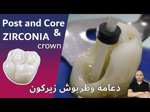 Broken Tooth Repair FIBER POST & CORE filling after Root Canal and Zirconia crown