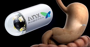 Remote-Controlled Pill Camera Can Help Diagnose Digestive Issues – Lifeboat News: The Blog