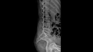 clip-3656276011-lateral-x-ray-straight-spine-imaging-lumbar--