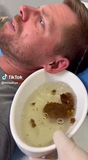 Effective Ear Cleaning Techniques for Healthy Ears
