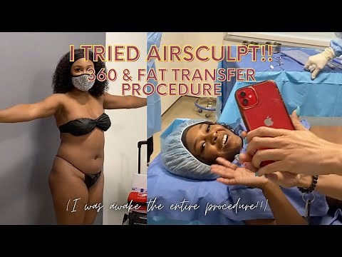 AirSculpt Full Procedure (360 + Fat Transfer) Review With Elite Body Sculpture