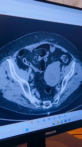 La tecnologia robotica rivoluziona il trattamento del tumore al colon 🦾💡. Precisione e innovazione per una cura sempre più efficace. 💪❤️ #Salute #RoboticaMedica #tumore #colon | Dottor Francesco Sammartino