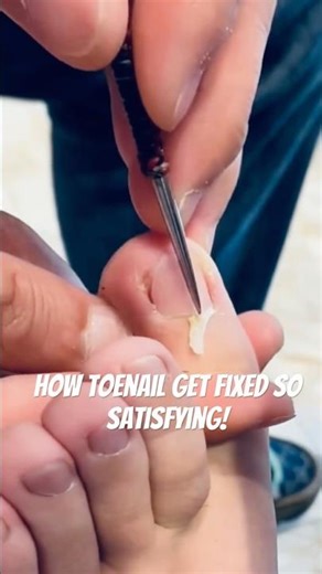 Learn How to Trim Your Toenails Like a Pro in Just a Few Minutes!