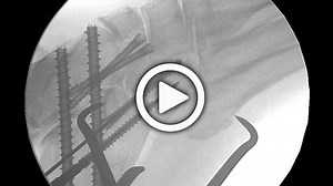 Triple Arthrodesis Cadaveric Lab with Nicholas Abidi, MD