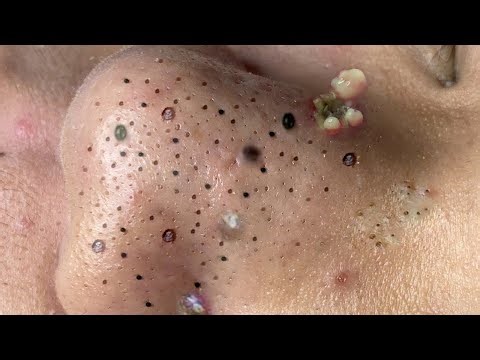 Deep Pore Blackhead Removal – Satisfying Acne Extraction & Relaxing Skincare - 234117