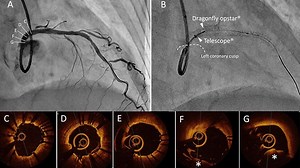Image in cardiology: Aorto-ostial lesion using TELESCOPE® in OCT-guided PCI