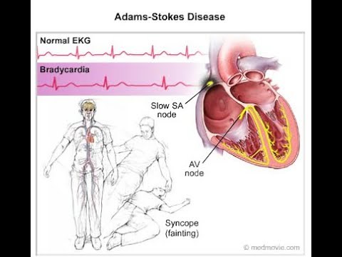 Adams Stokes Syndrome ; Definition, Causes, Symptoms, Diagnosis, Treatment