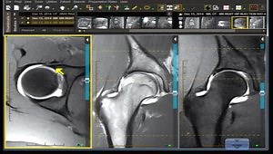 Protocols and Sequences: When to Consider Contrast in Hip MRI