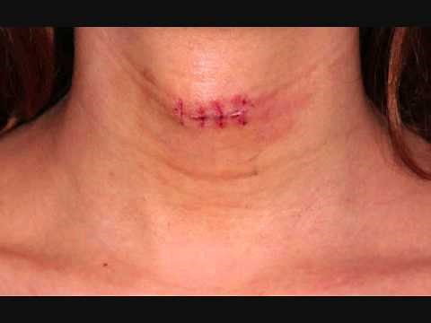 Larynx Adams Apple Reduction Surgery Before / After - Kehlkopf verkleinerungs Operation