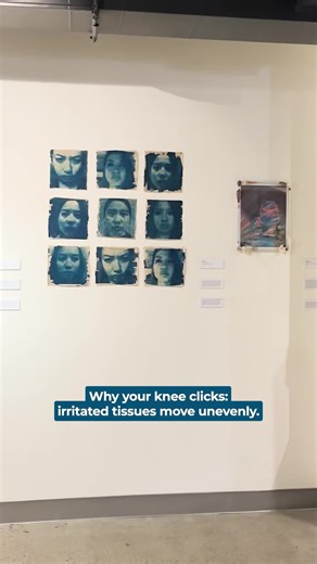A healthy knee moves like a well-oiled hinge. Each structure sliding at the right time, in the right direction, with barely a sound. Osteoarthritis throws off that choreography. Chronic inflammation causes the joint lining to swell, cartilage to thin, and surrounding tissues to stiffen. When those structures lose their timing, movement becomes uneven. One tissue glides late, another catches early, and the result is a click, pop, or snap you can feel as much as hear. That sound is the knee correc