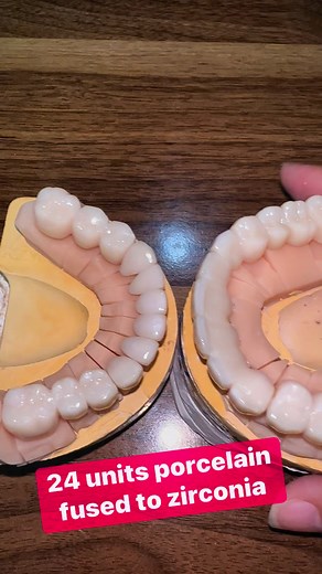 Porcelain fused to zirconia crowns are formed by porcelain being combined with zirconium oxide. The zirconia base has a white shade and is layered with porcelain to match final restoration. Zirconia is even making it more durable to withstand forceful mastication and grinding. If properly maintained, zirconia restorations can last a patient's lifetime. | Dr. Mae Abella Dental Clinic