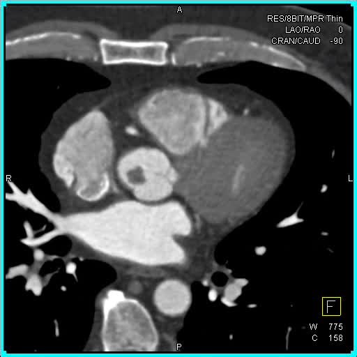 12 reactions | Papillary fibroelastoma axial 4D #ctisus | CTisus: Cutting edge information on body CT (Computed tomography). | Facebook