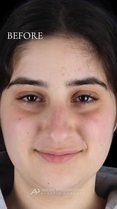 Sometimes the smallest changes make the biggest difference, both in the mirror and in how we feel. When this young woman came to see me at 18, she shared how the bump on her nose, the fuller tip, and the way her tip dipped when she smiled had always bothered her. She didn’t want to look like someone else. She just wanted her nose to feel more like herself. We decided on a closed rhinoplasty using a dorsal preservation technique with no external incisions. I refined the tip, added a touch of rota