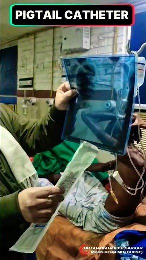Pigtail Catheter for Pleural Effusion Drainage | Pigtail Catheter Insertion: Step-by-Step Procedure